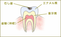 C1：歯の表面（エナメル質）の虫歯