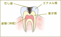 C2：歯のなか（象牙質）の虫歯
