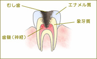 C3：歯の神経（歯髄）まで進行した虫歯